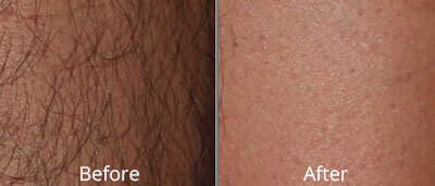 Laser Hair Removal Before and After Photos at Chesapeake Vein Center and Medspa in Virginia