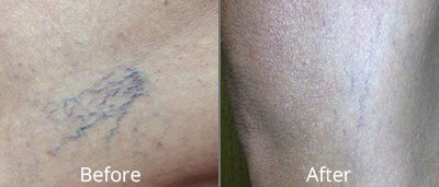 Spider Vein Treatment Before and After Photos at Chesapeake Vein Center and Medspa in Virginia