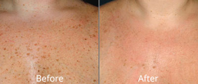 Photofacial before and afters at Chesapeake Vein Center and Medspa in Virginia