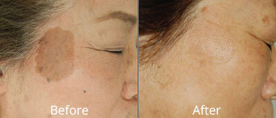 Photofacials before and after photos at Chesapeake Vein Center and Medspa in Virginia