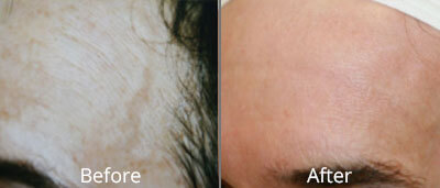 Photofacials before and after photos at Chesapeake Vein Center and Medspa in Virginia