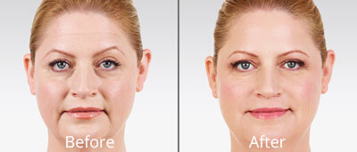 Juvéderm before and after photos at Chesapeake Vein Center and Medspa in Virginia