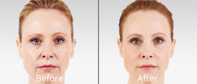 Juvéderm before and after pics at Chesapeake Vein Center and Medspa in Virginia