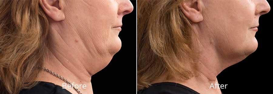 coolsculpting double chin before after Chesapeake