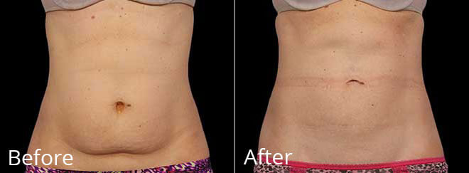 before after coolsculpting treatment Chesapeake