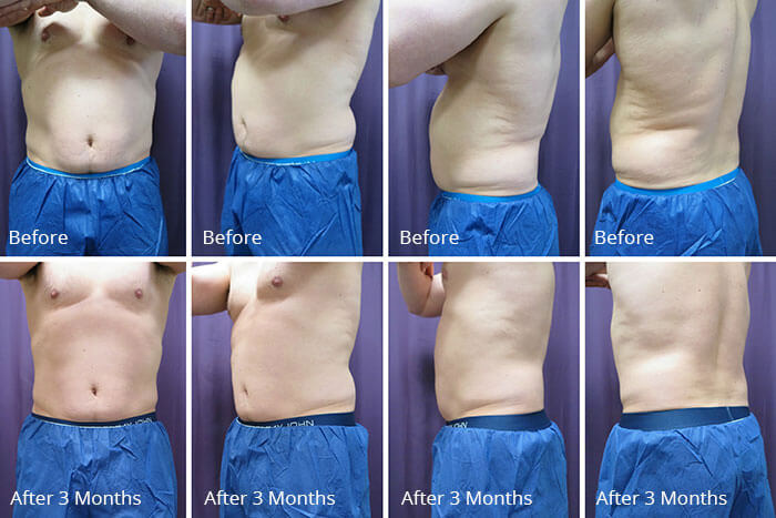 Before After coolsculpting VA